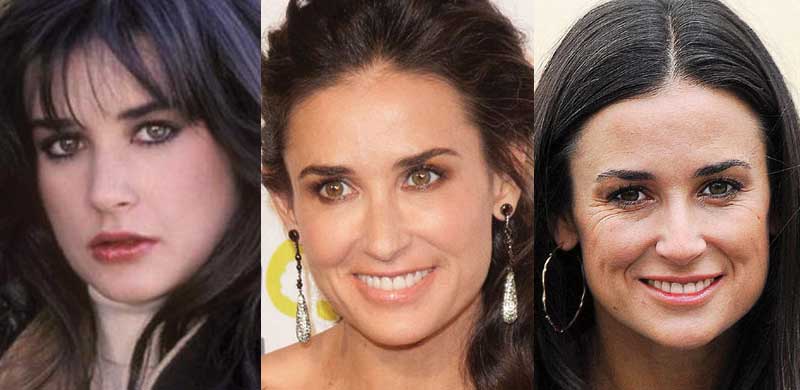 Demi Moore Plastic Surgery Before and After Pictures 2018