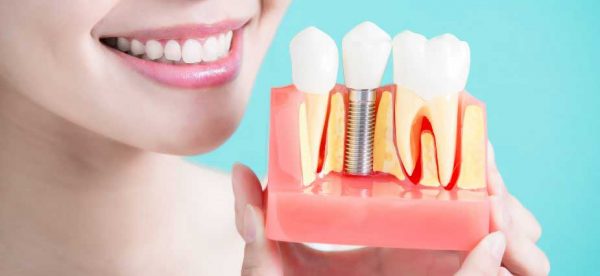 dental-implant-cost-in-usa-2024