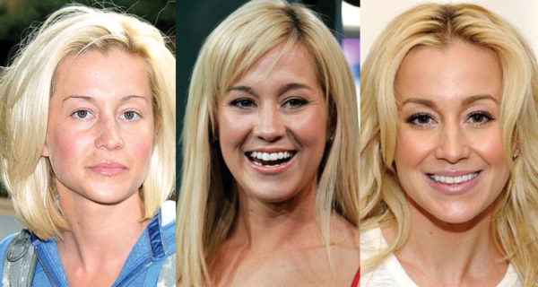Kellie Pickler Plastic Surgery Before And After Pictures 2024 