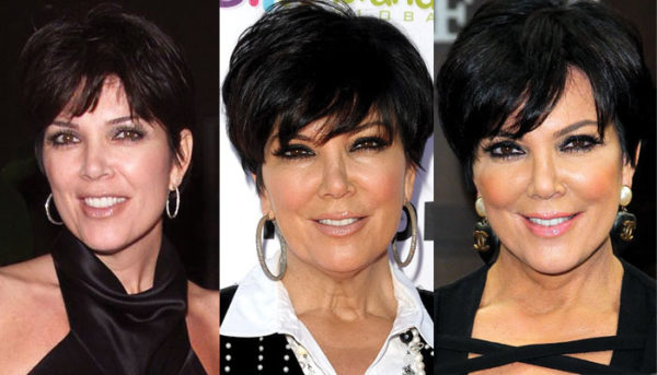 Kris Jenner Plastic Surgery Before And After Pictures 2023